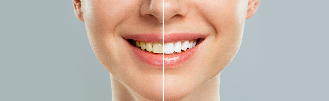 Teeth-Whitening