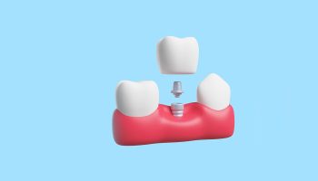 Are Dental Implants Really Worth It? What Port Orange Residents Should Know Before Deciding